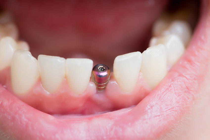 Implant pojedynczego zęba