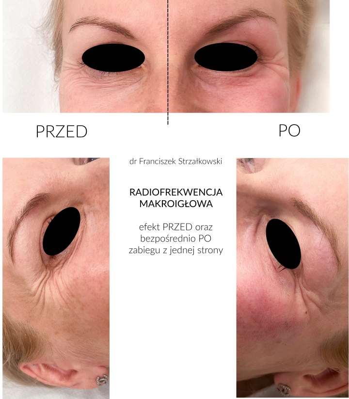 Przed i po zabiegu Przed i po zabiegu