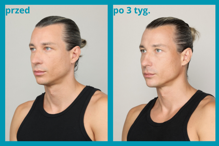 Zabieg Genefill DX Masculinization Zabieg Genefill DX Masculinization