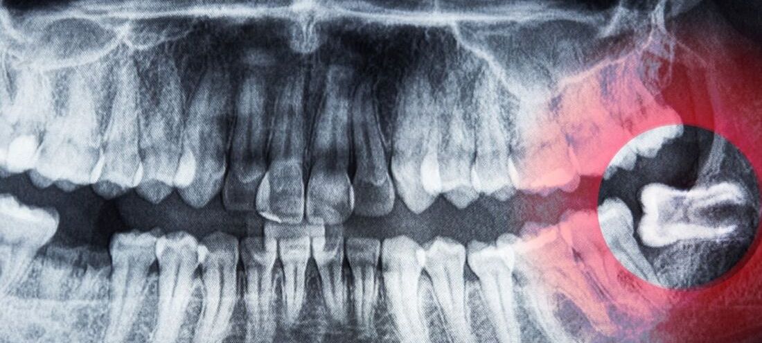 Ósemki pod lupą chirurga. Kiedy i dlaczego trzeba je usuwać?