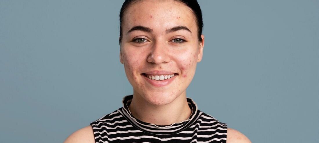 Trądzik pospolity: przyczyny, objawy i nowoczesne metody leczenia