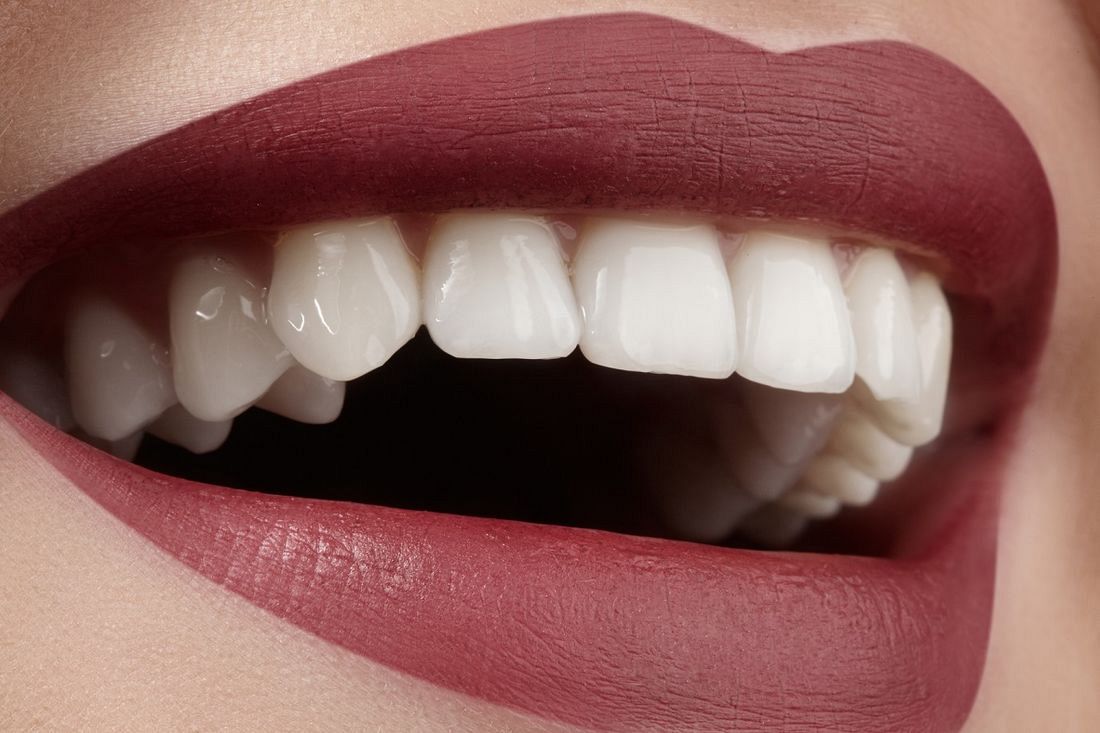 Czym jest bonding zębów? 