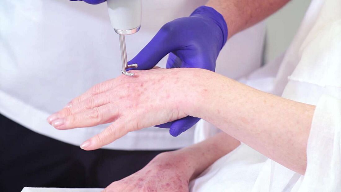 Jak laser Discovery Pico usuwa przebarwienia skóry na dłoniach i twarzy? Film z zabiegu! 