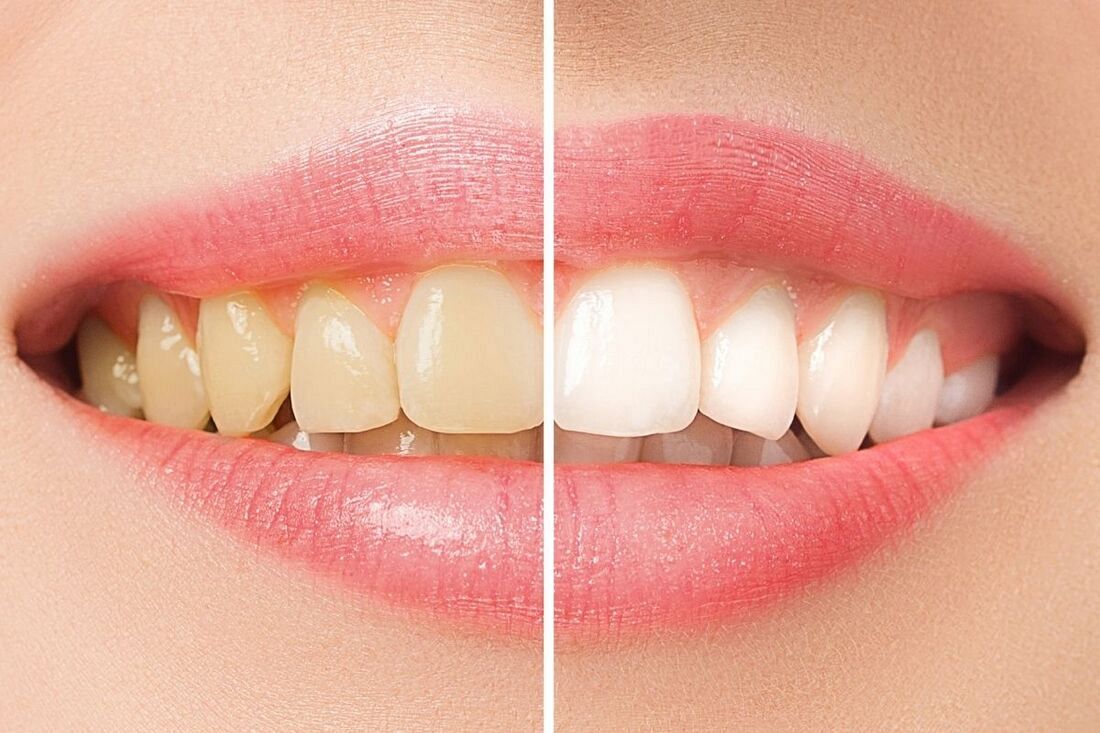 Z jasnymi zębami Ci do twarzy – o metodach rozjaśniania i wybielana 