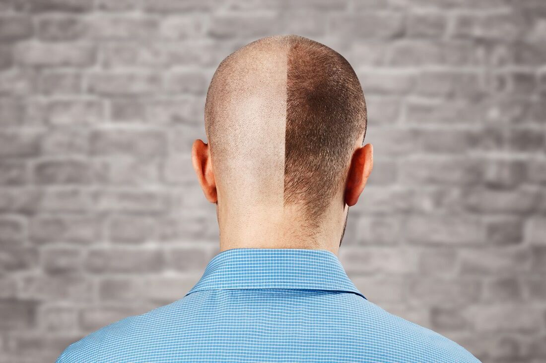 10 rzeczy, które musisz wiedzieć o przeszczepie włosów metodą FUE 