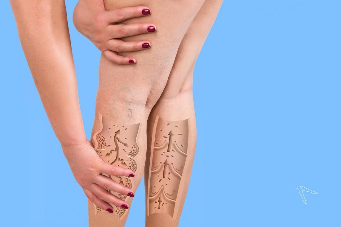 Jakie zabiegi pomagają na lipodemię? 