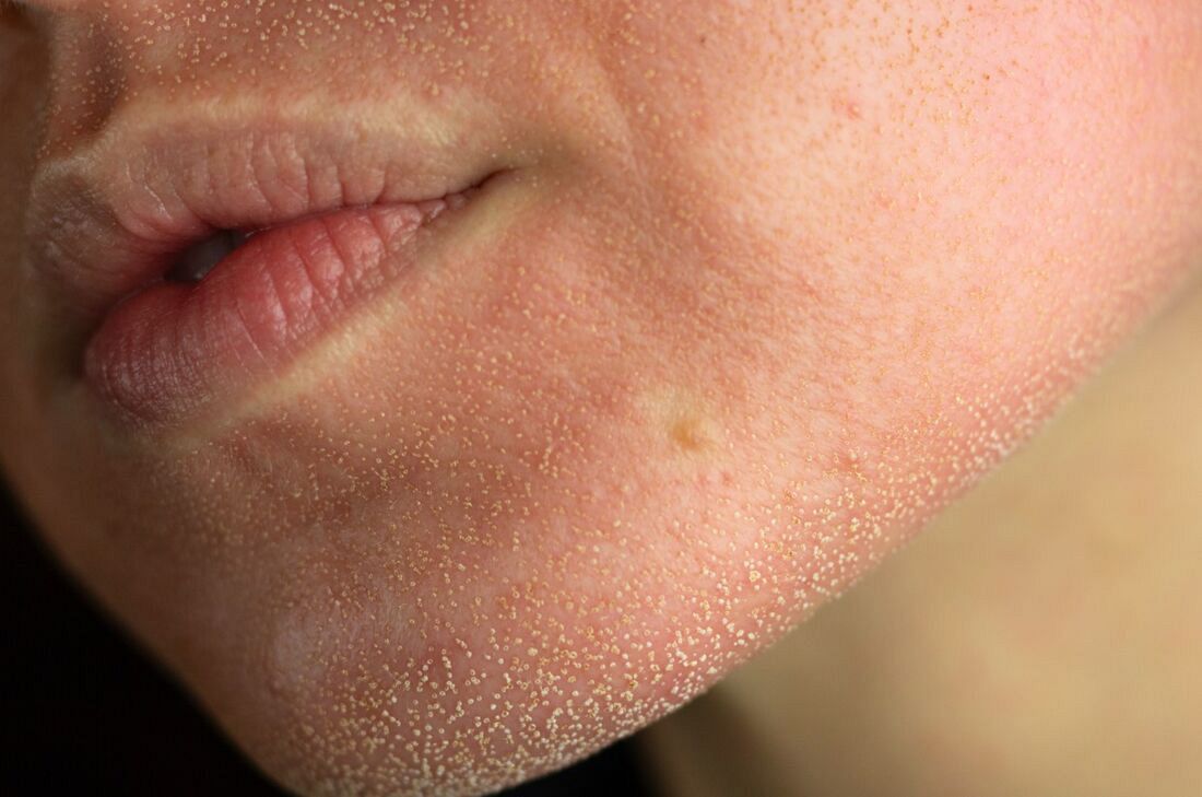 Laseroterapia jako proces terapeutyczny – rola pielęgnacji pozabiegowej w kontroli efektu klinicznego 