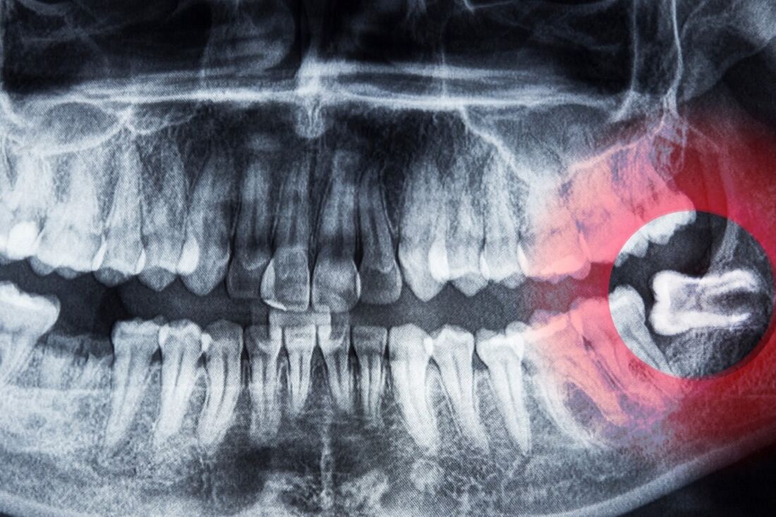 Ósemki pod lupą chirurga. Kiedy i dlaczego trzeba je usuwać? 