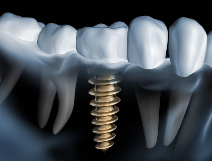 Implanty stomatologiczne – czy ich jakość ma znaczenie? 