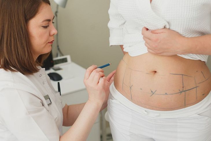 Abdominoplastyka odwrócona – ryzyko większe od korzyści? 