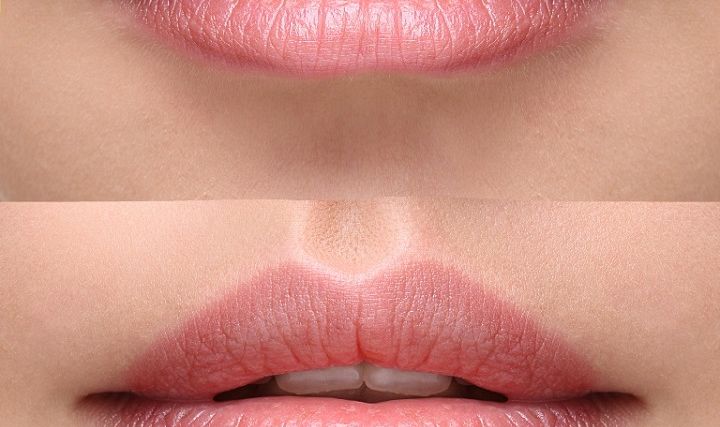 7 błędów powiększania ust kwasem hialuronowym
