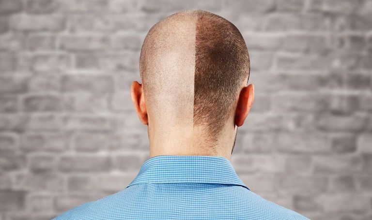 10 rzeczy, które musisz wiedzieć o przeszczepie włosów metodą FUE