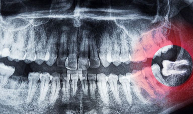Ósemki pod lupą chirurga. Kiedy i dlaczego trzeba je usuwać?