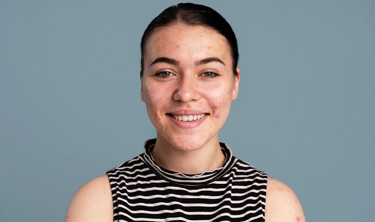 Trądzik pospolity: przyczyny, objawy i nowoczesne metody leczenia