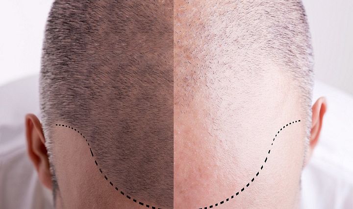 Przełom w leczeniu łysienia u mężczyzn