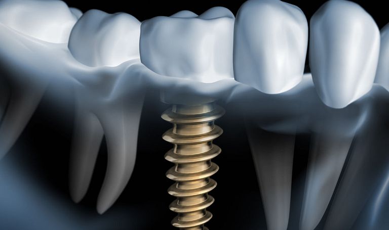 Implanty stomatologiczne – czy ich jakość ma znaczenie?