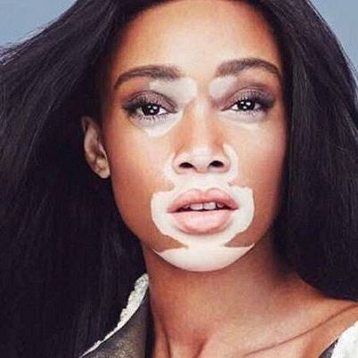 Winnie Harlow