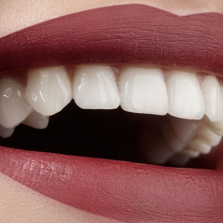 Czym jest bonding zębów?