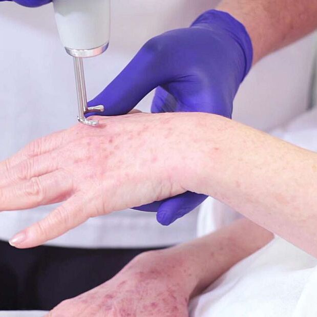 Jak laser Discovery Pico usuwa przebarwienia skóry na dłoniach i twarzy? Film z zabiegu!