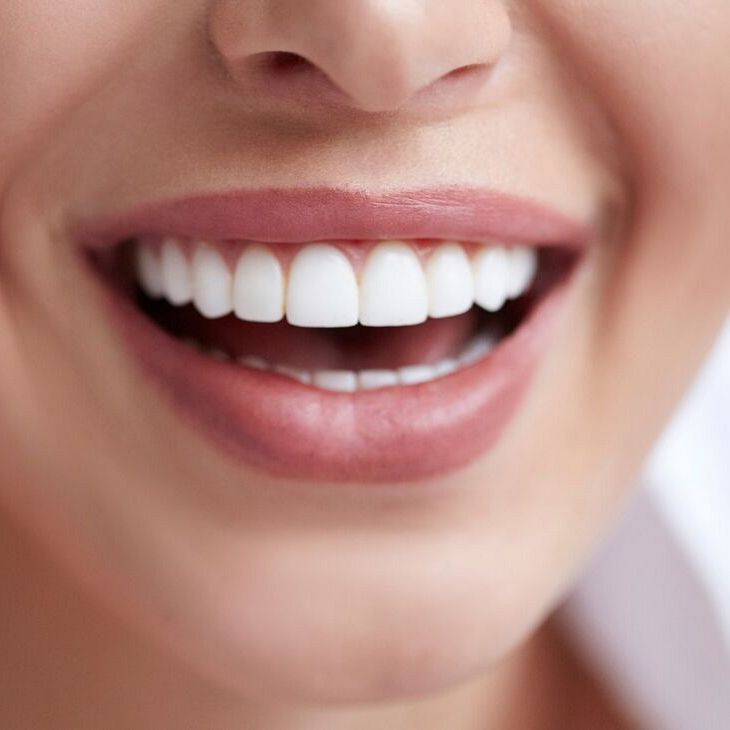Bonding, licówki pełnoceramiczne oraz flow injection – szybki sposób na poprawę wyglądu zębów