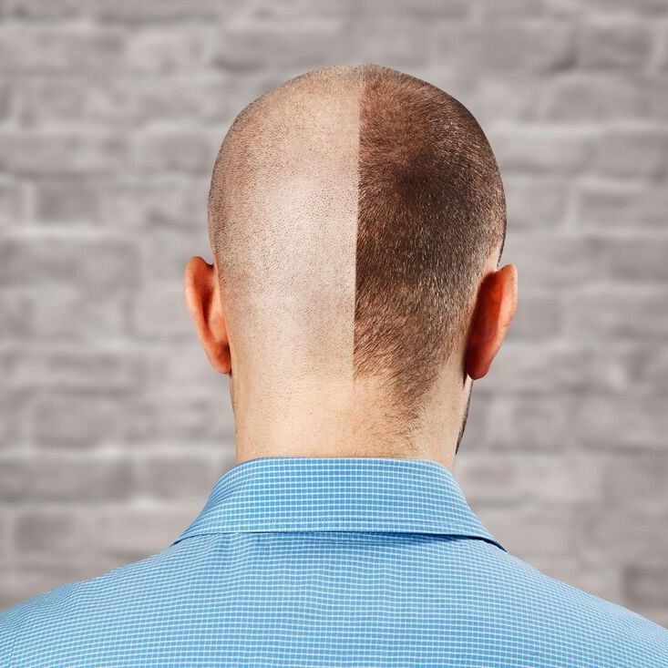 10 rzeczy, które musisz wiedzieć o przeszczepie włosów metodą FUE