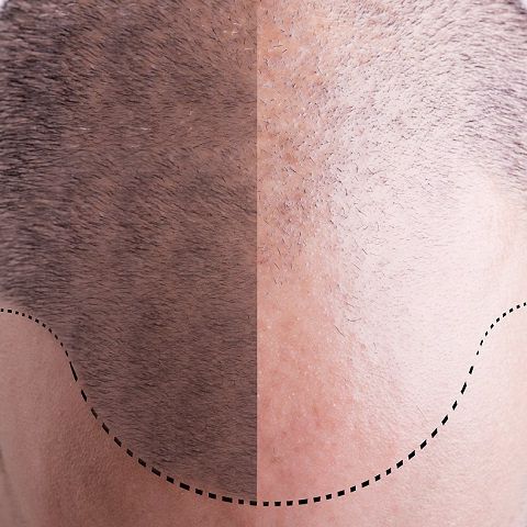 Przełom w leczeniu łysienia u mężczyzn